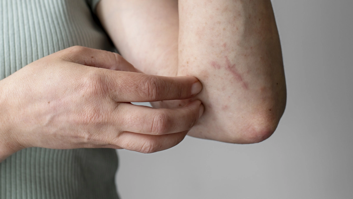 Je žihľavka alergia alebo nie?