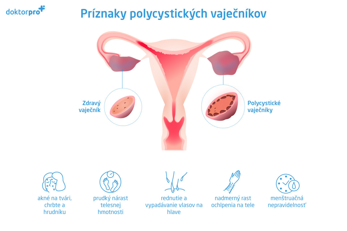 Príznaky polycystických vaječníkov