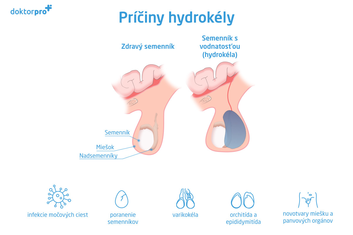 Príčiny hydrokély