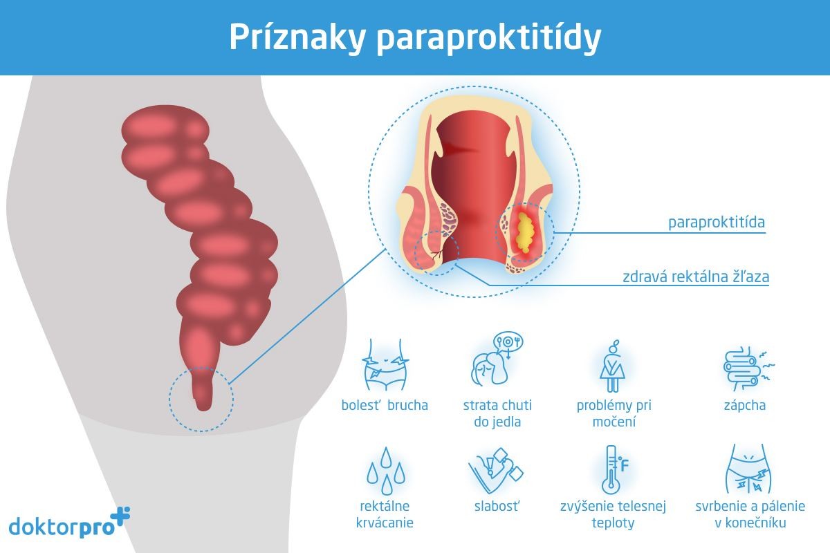 Príznaky paraproktitídy