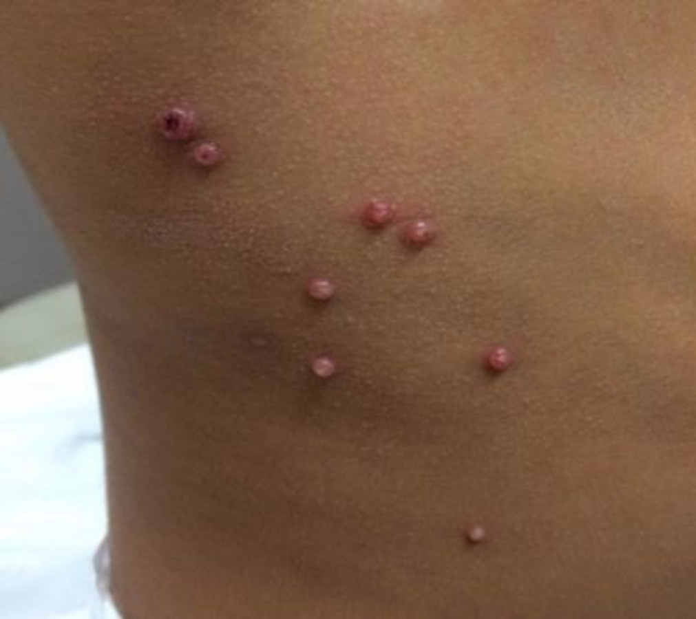 kontagiózne moluskum na krku