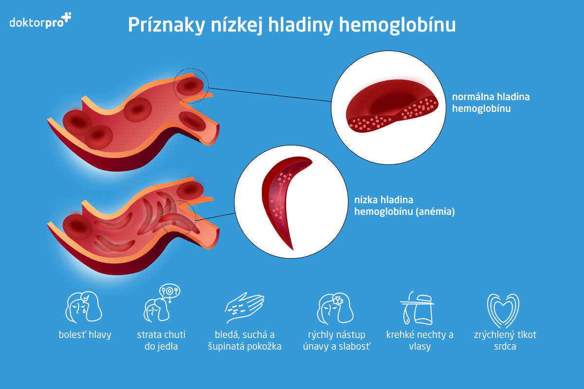 Príznaky nízkej hladiny hemoglobínu