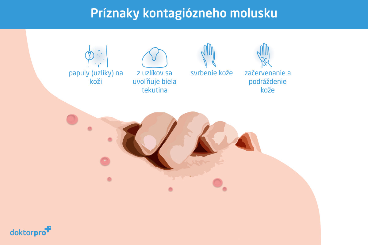 Príznaky kontagiózneho molusku