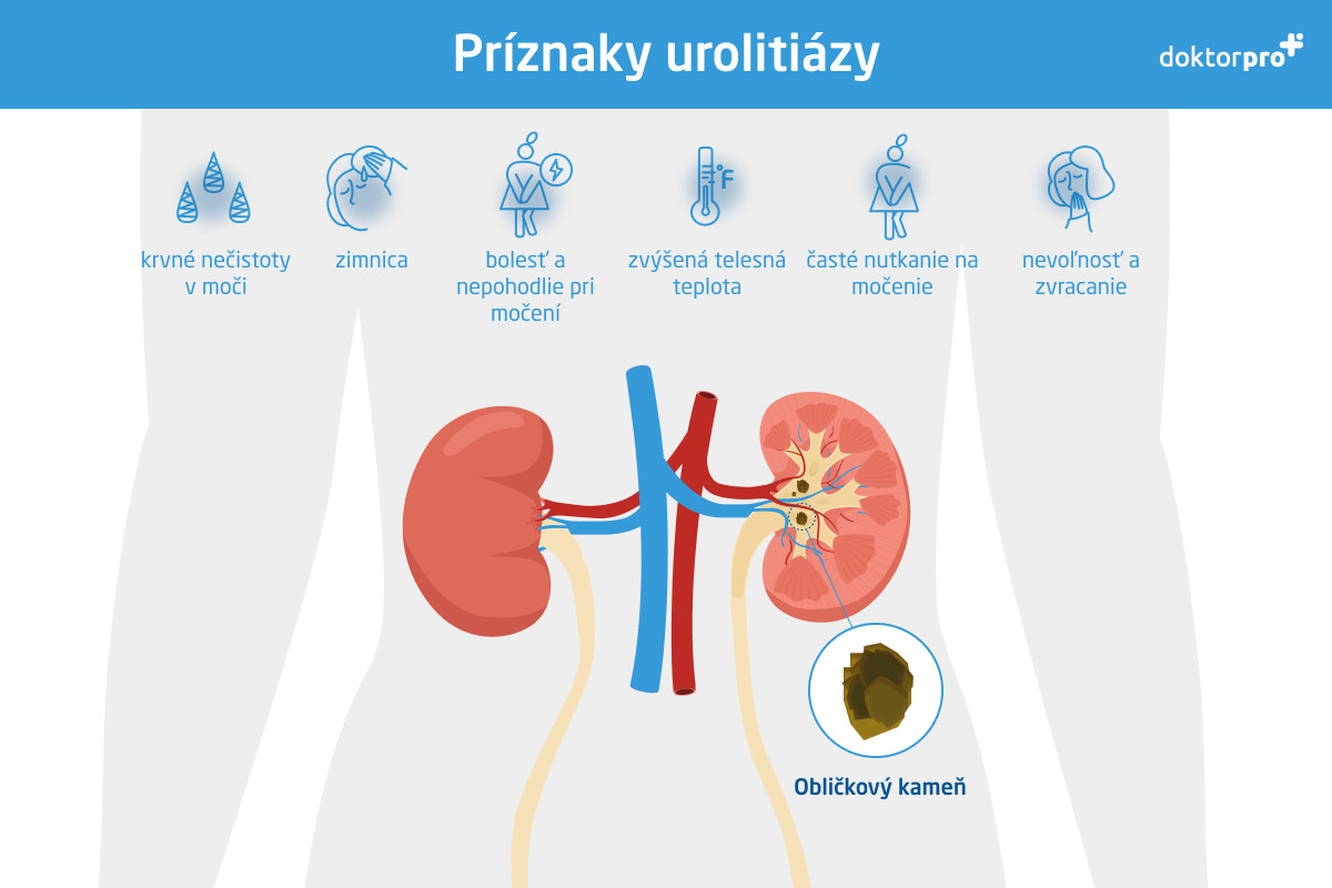 Príznaky urolitiázy