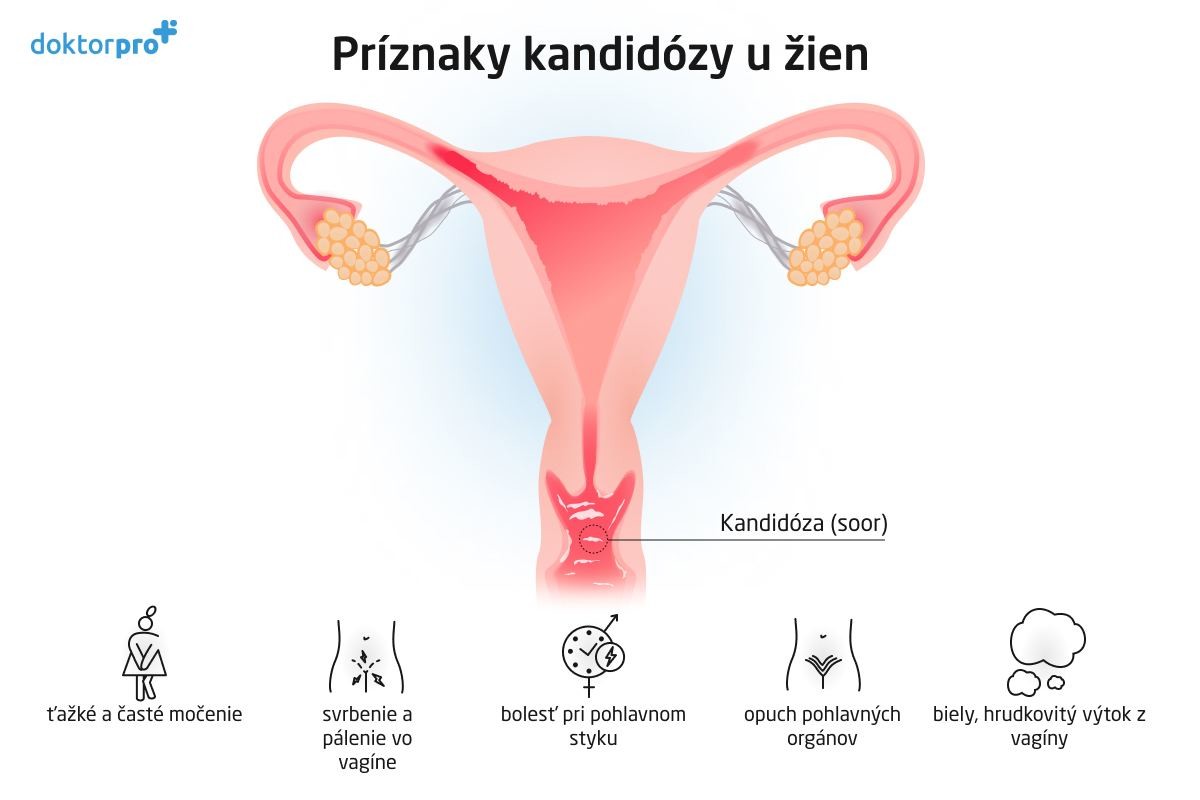 Príznaky kandidózy u žien