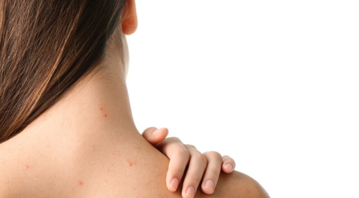 Čo spôsobuje akné na chrbte a ako ho liečiť?