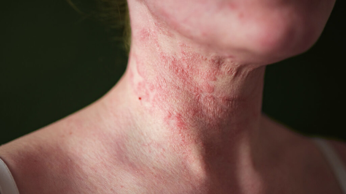 Atopická dermatitída na krku
