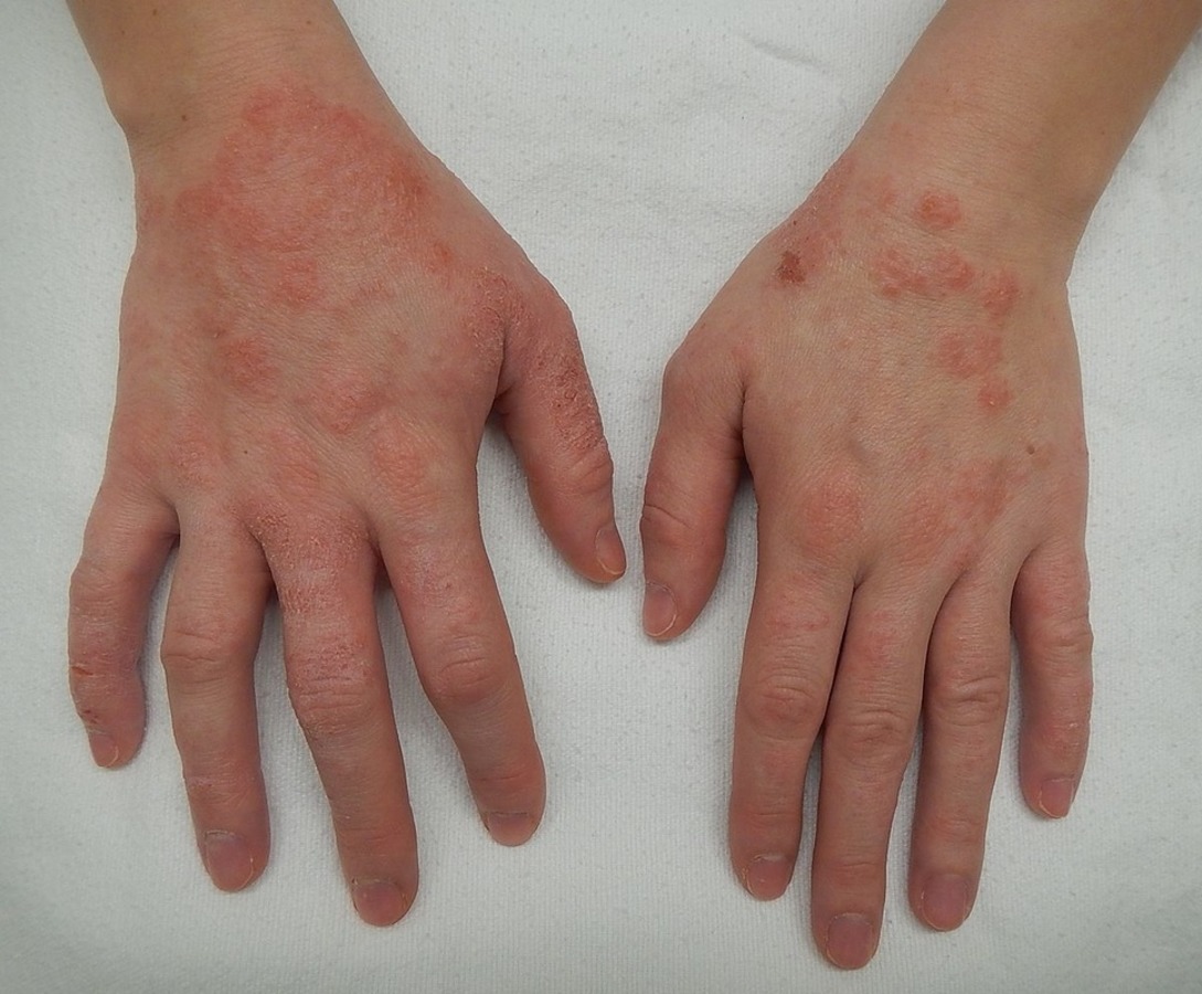 Infekčná dermatitída