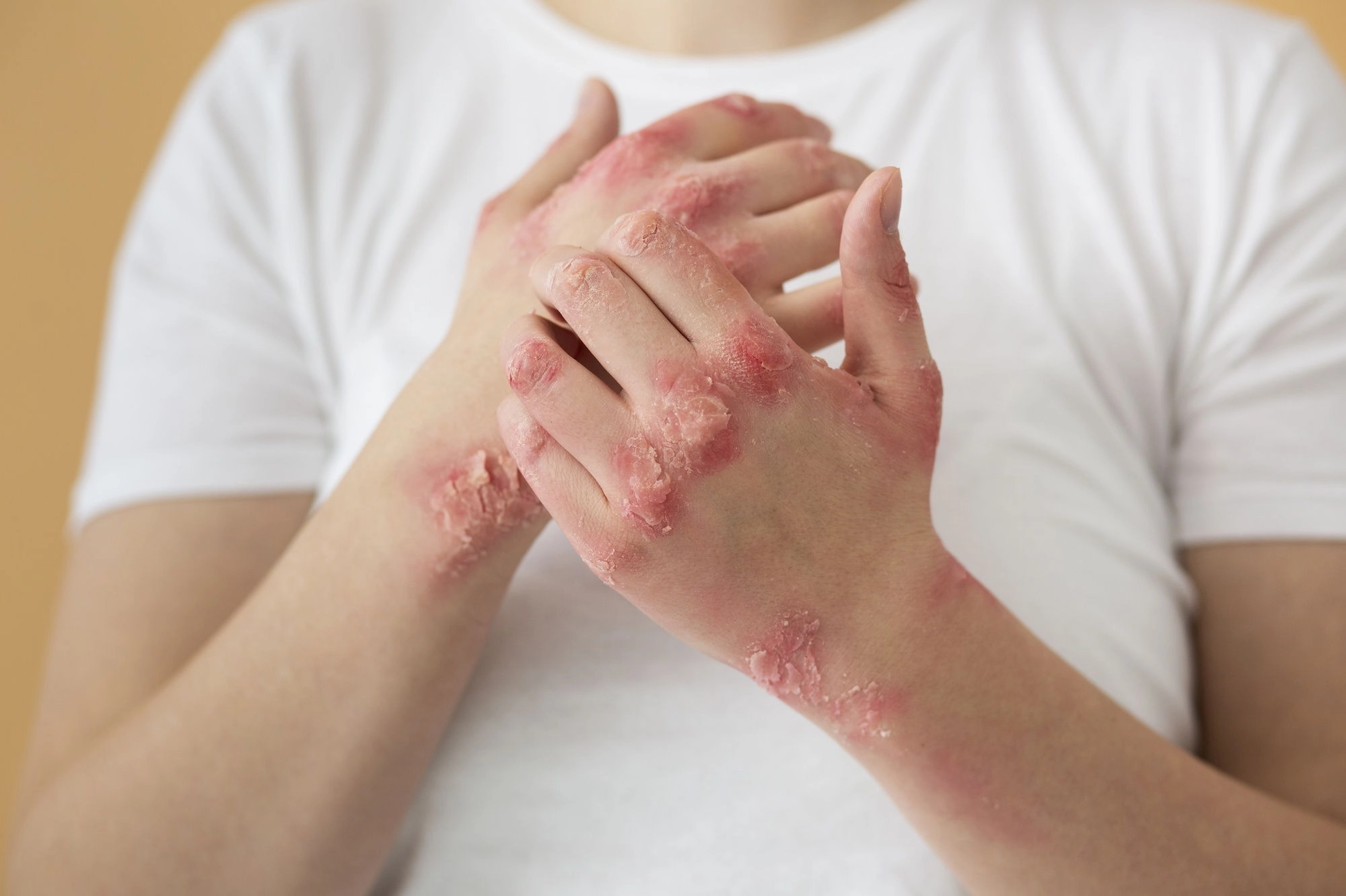 Čo je psoriáza a ako ju liečiť?