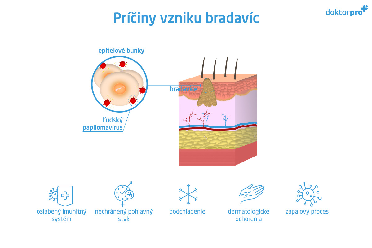 Príčiny vzniku bradavíc