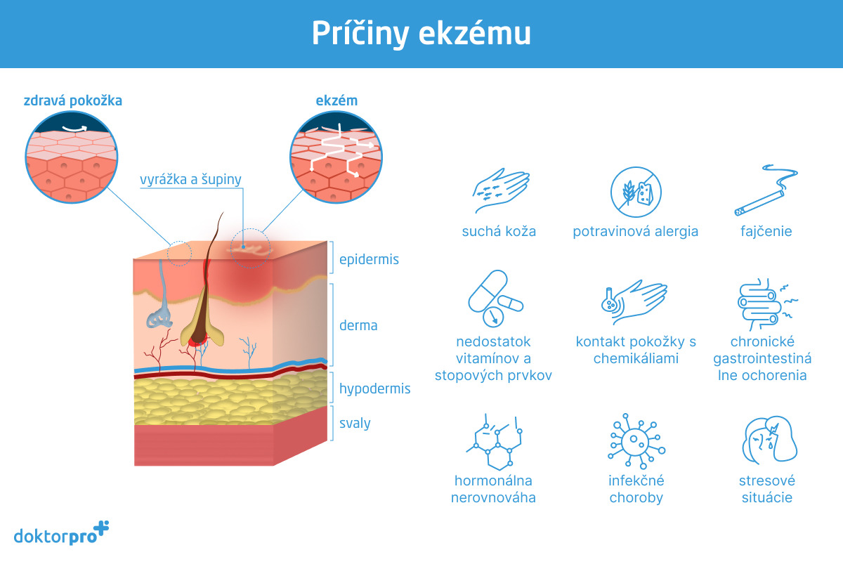 Príčiny ekzému