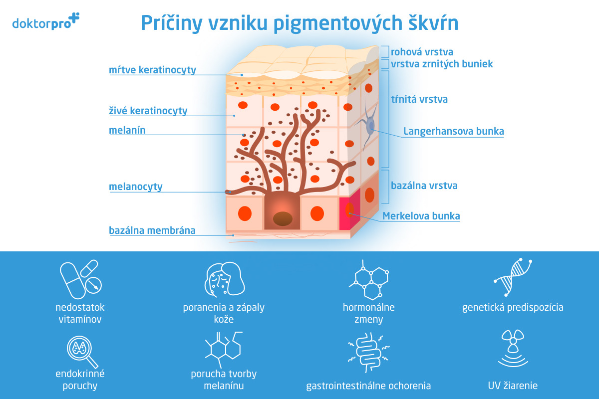 Príčiny vzniku pigmentových škvŕn
