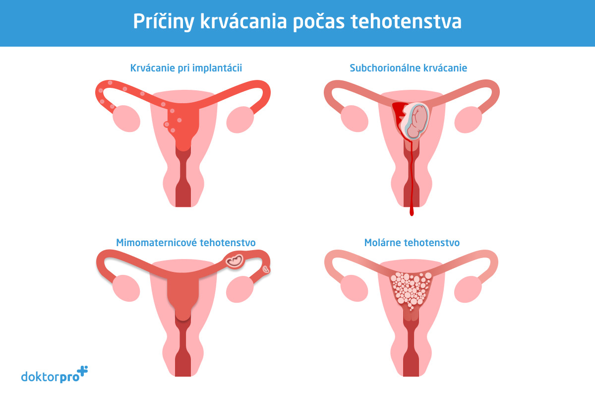 Príčiny krvácania počas tehotenstva