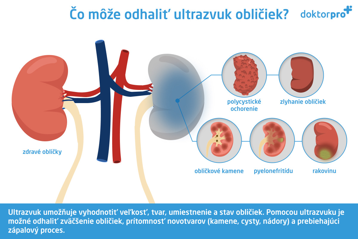 Čo môže odhaliť ultrazvuk obličiek?