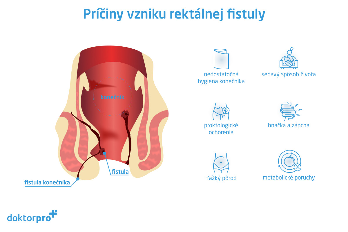 Príčiny vzniku rektálnej fistuly