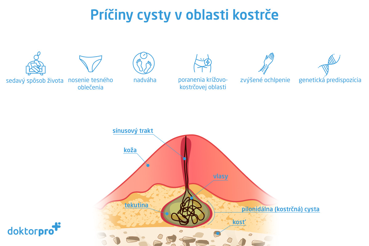 Príčiny cysty v oblasti kostrče