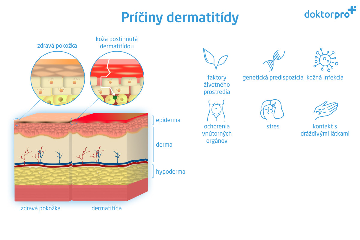 Príčiny dermatitídy