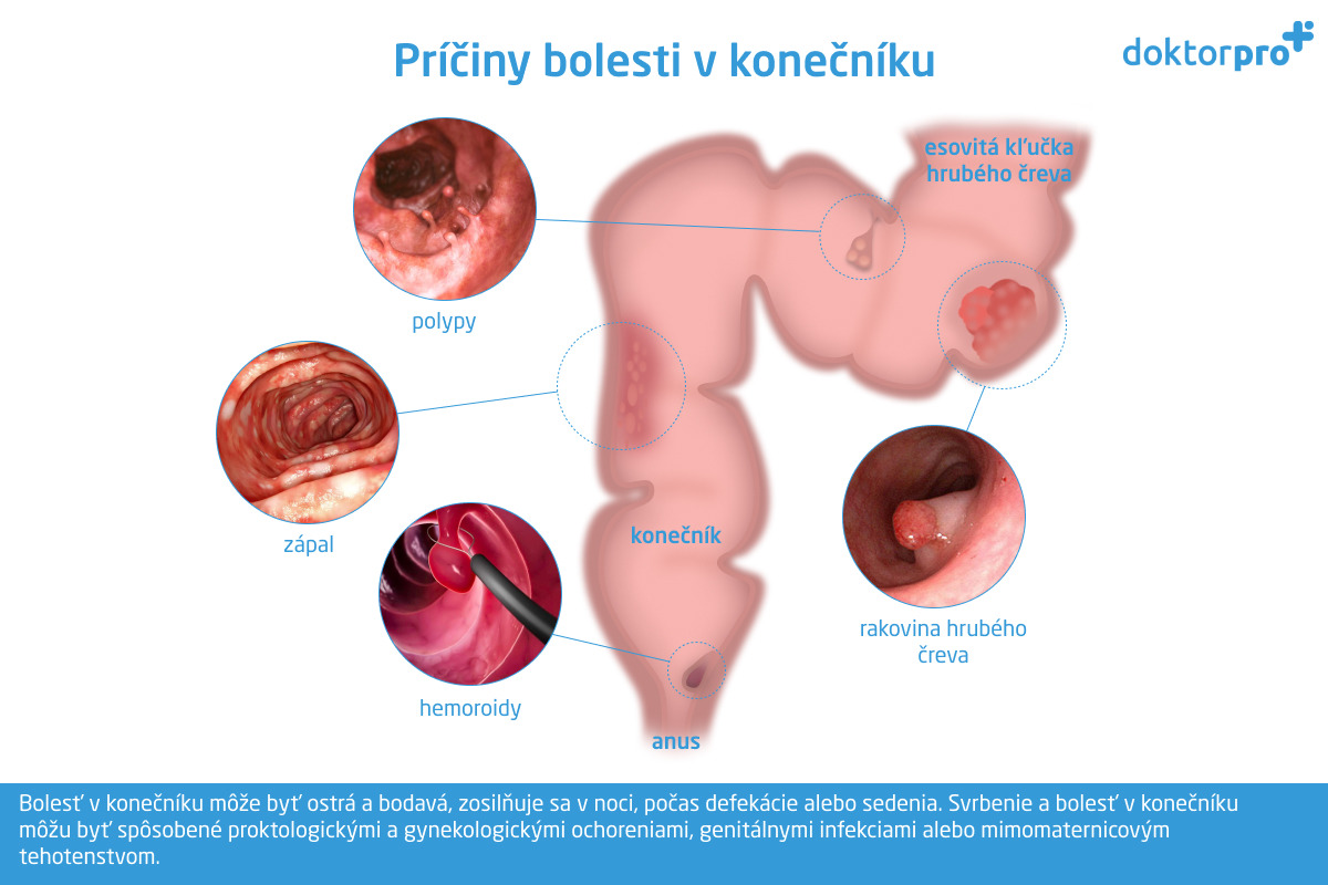 Príčiny bolesti v konečníku