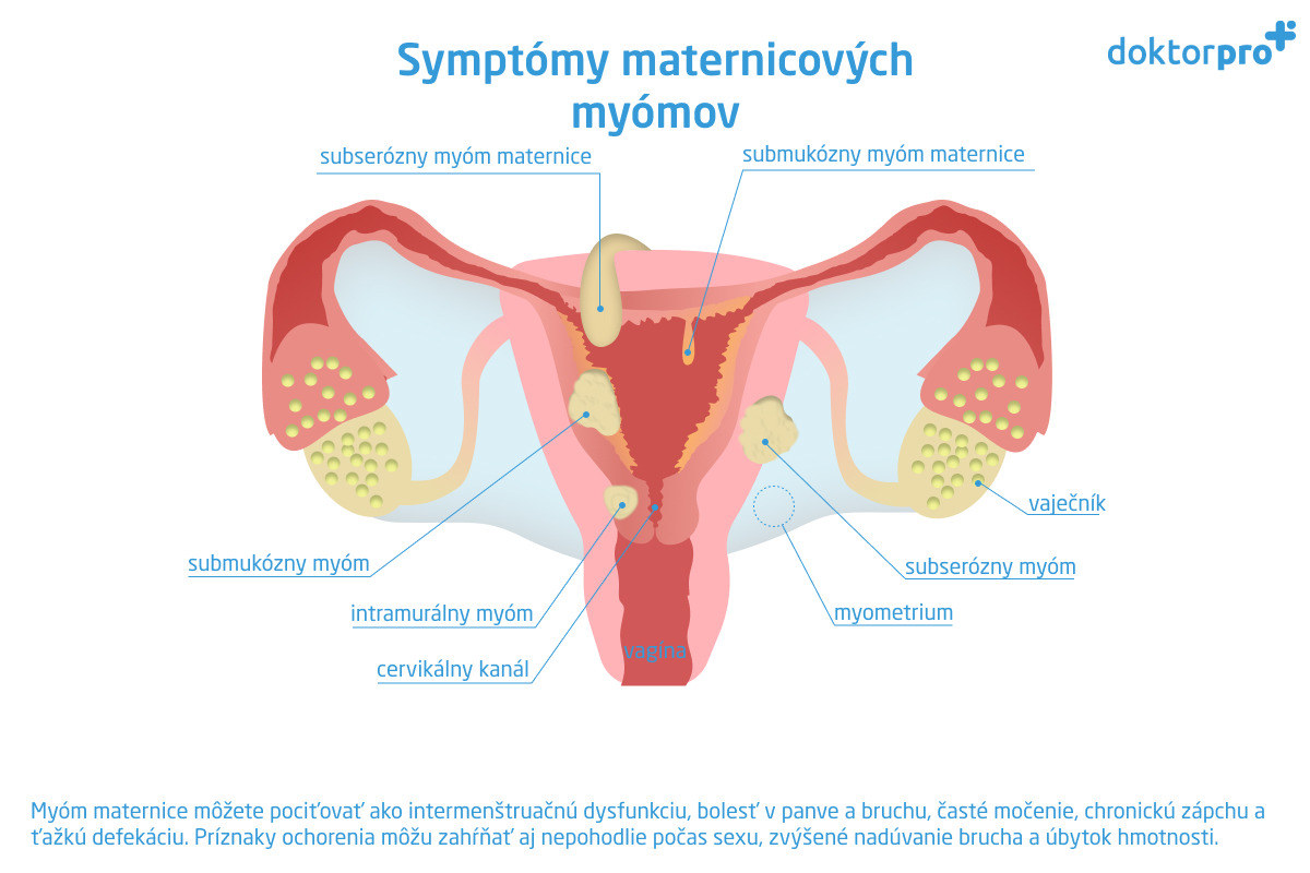 Symptómy maternicových myómov