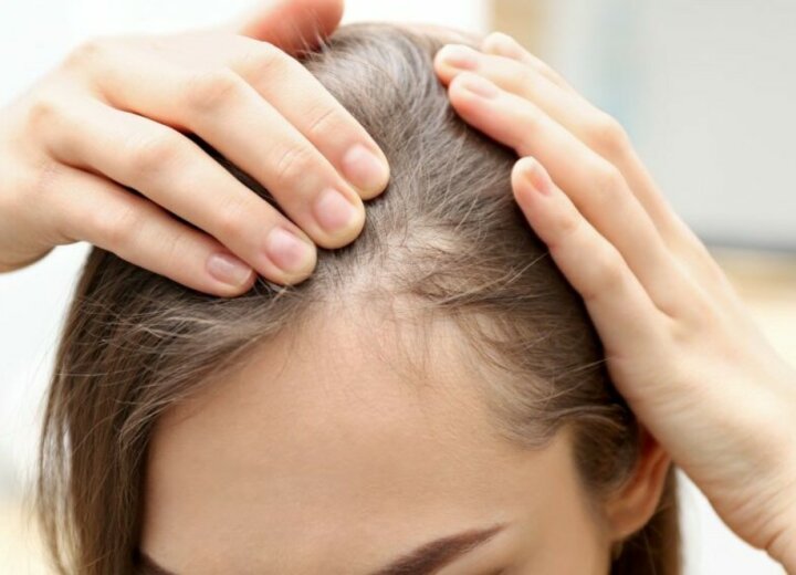 Aké sú príčiny vypadávania vlasov a ako to zastaviť?