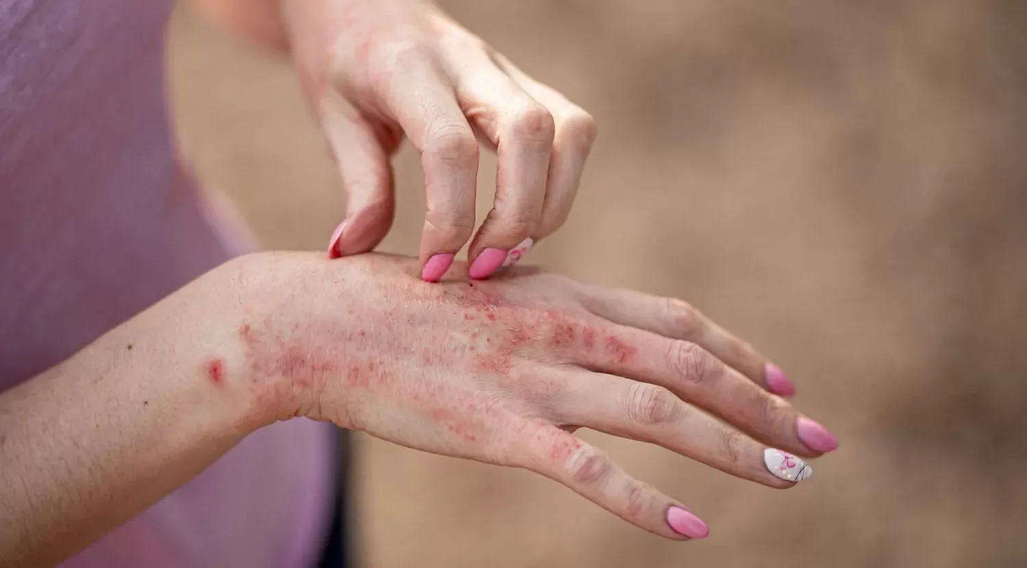 Príznaky, príčiny a liečba kontaktnej dermatitídy