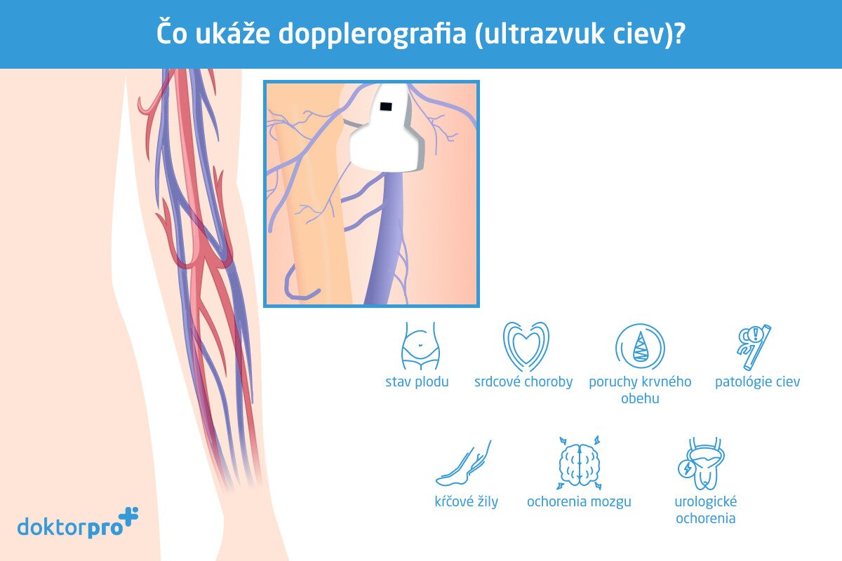 Čo ukáže dopplerografia (ultrazvuk ciev)?