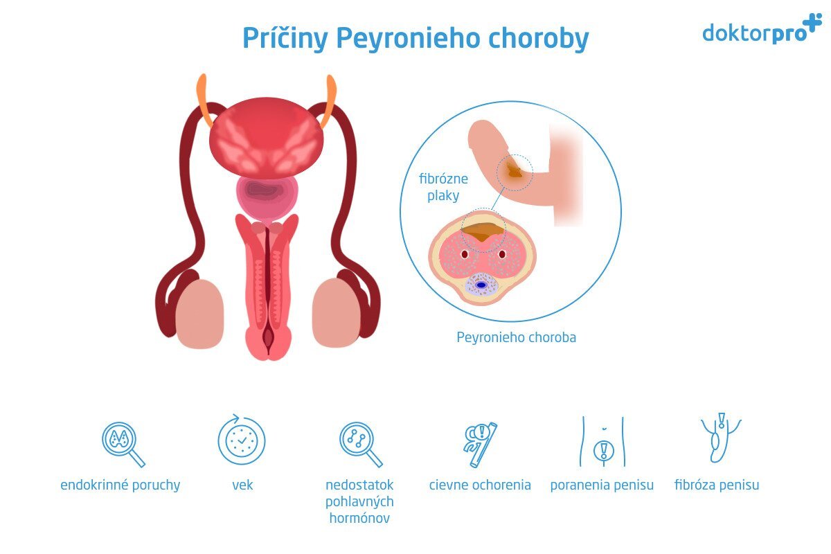 Príčiny Peyronieho choroby