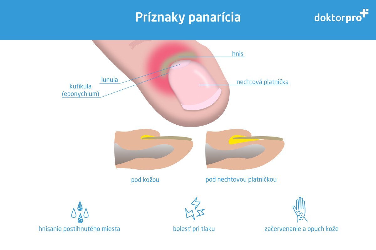 Príznaky panarícia