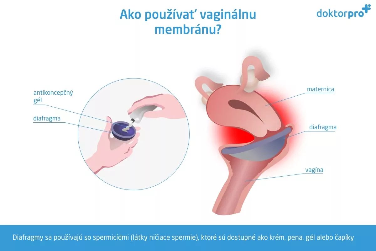Ako používať vaginálnu membránu?