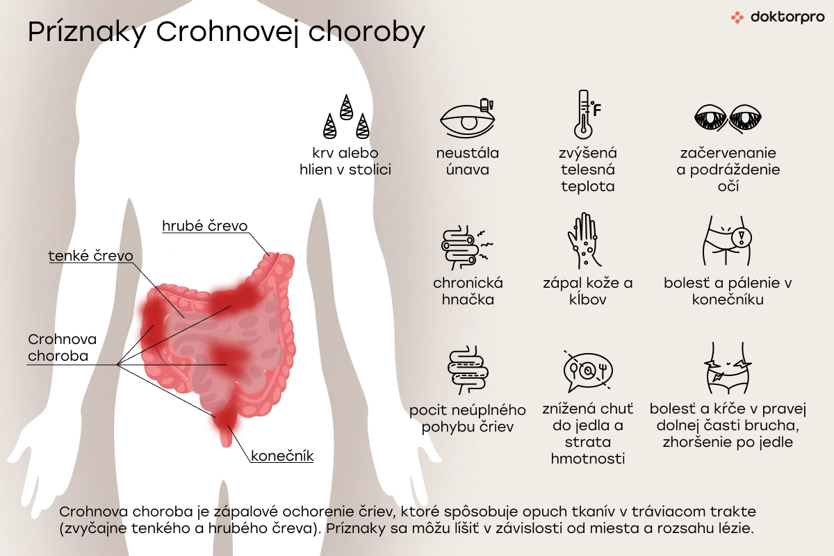 Príznaky Crohnovej choroby