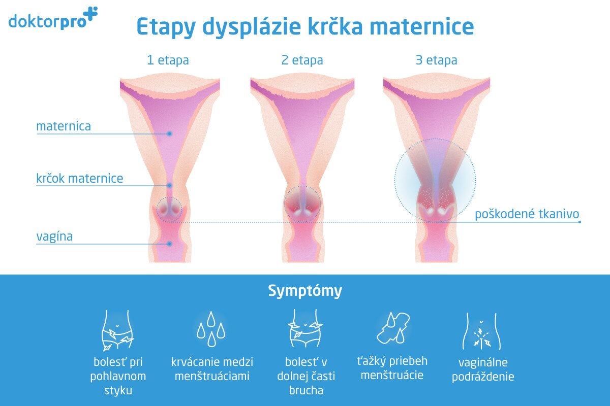 Etapy dysplázie krčka maternice