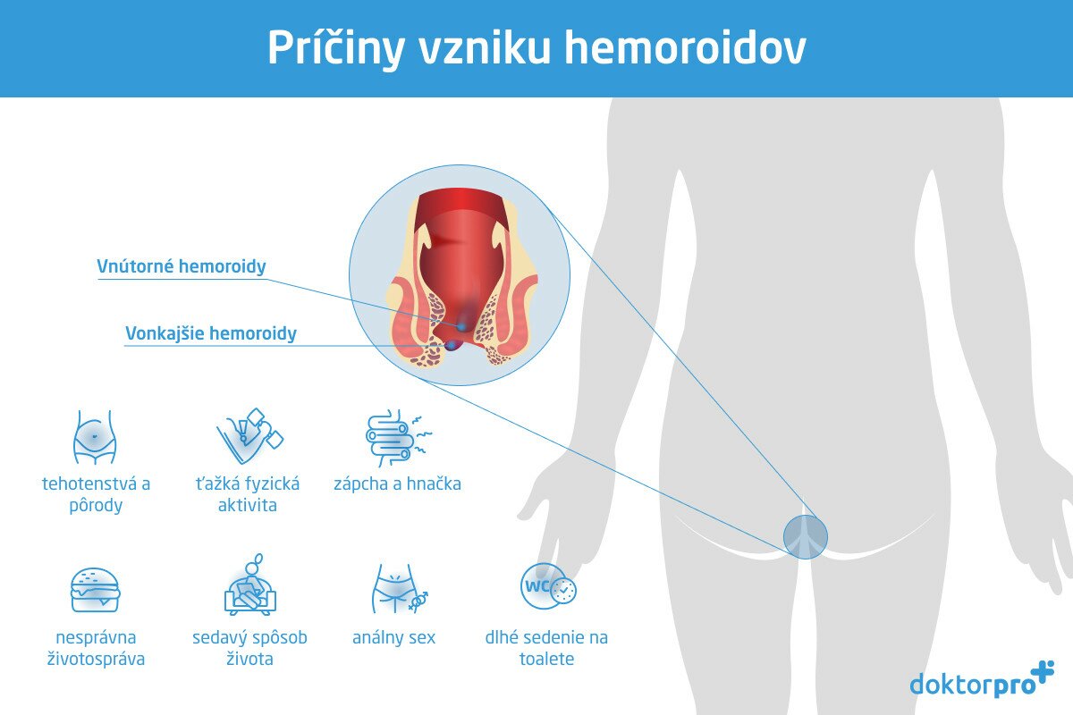 Príčiny vzniku hemoroidov