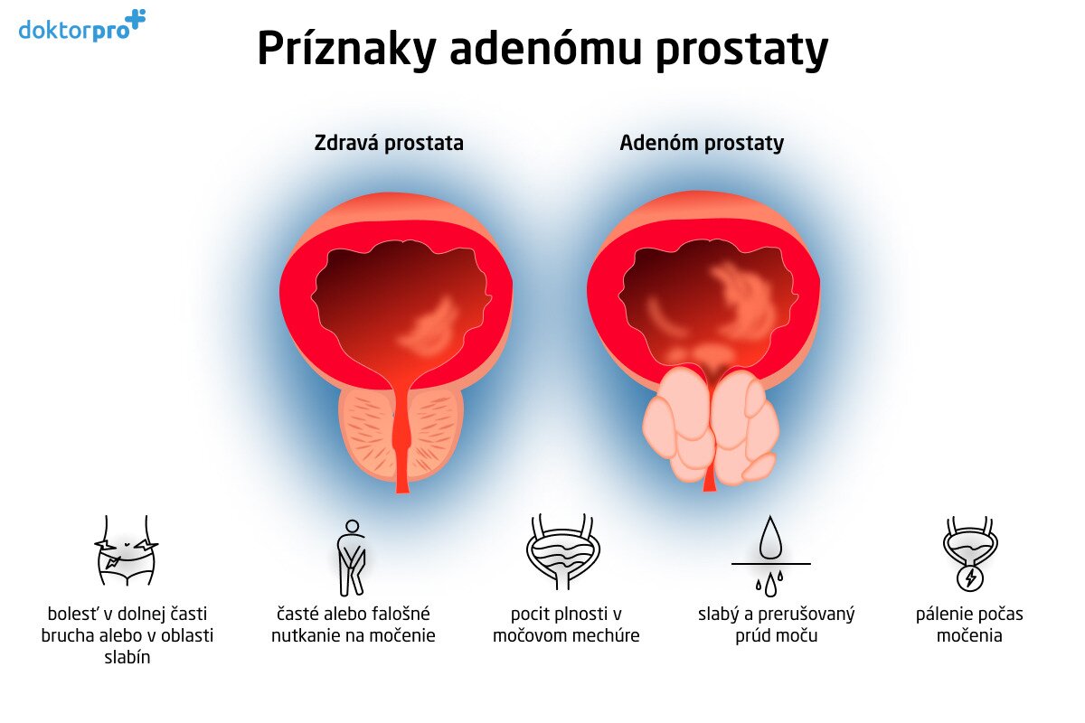 Príznaky adenómu prostaty
