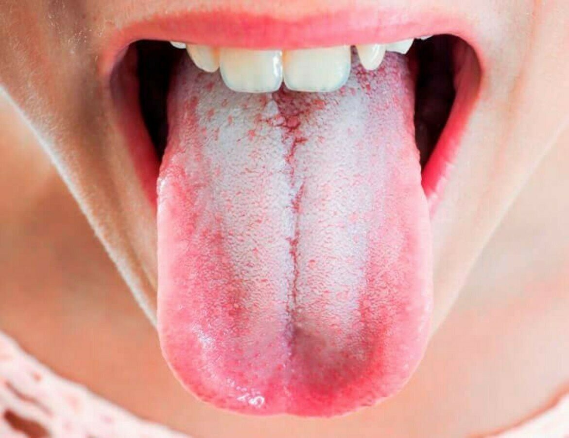 helicobacter pylori na jazyku