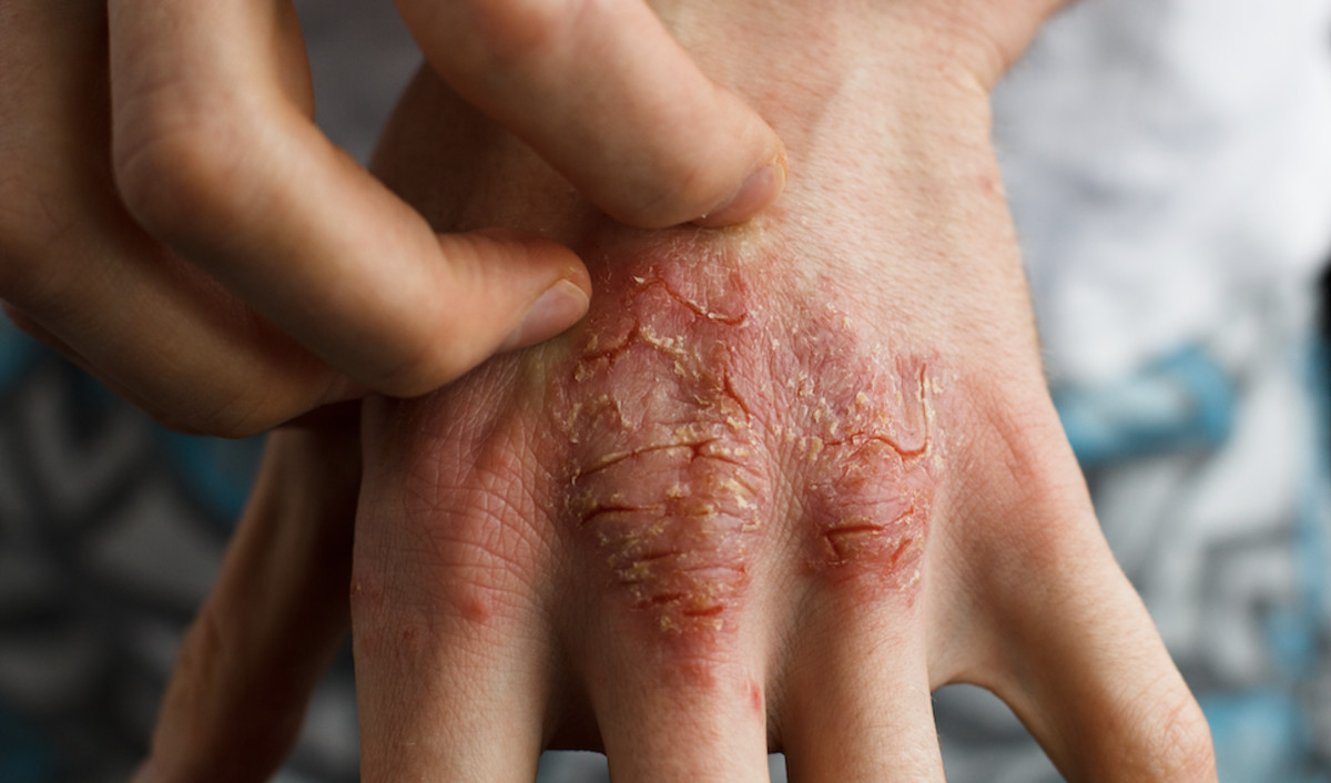 atopická dermatitída na rukách