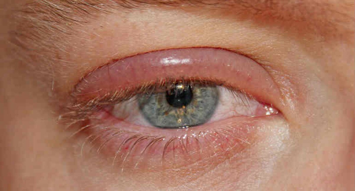 Demodikóza oči