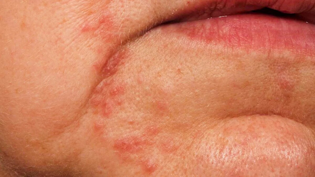Vyrážky na tvári pri ochorení pečene